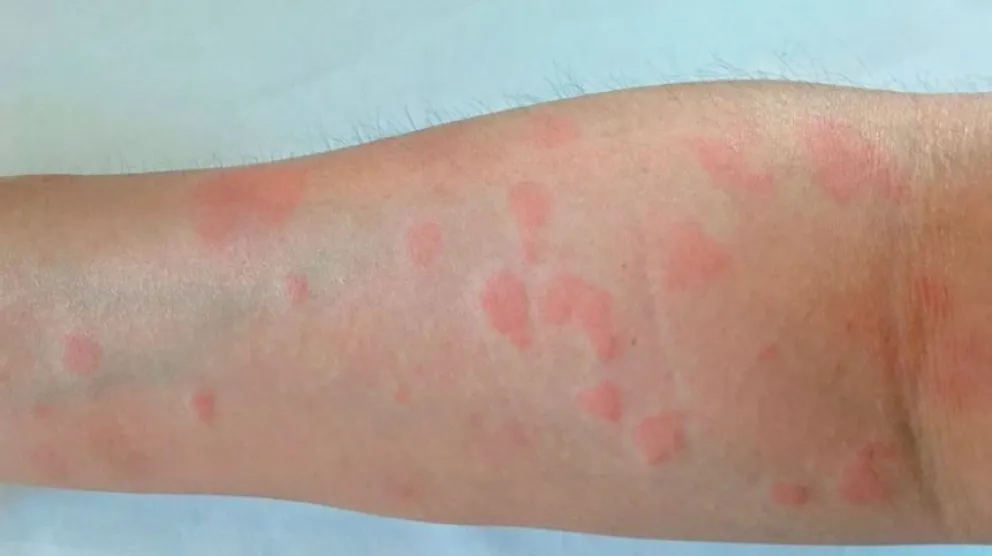 Lupus: cómo es la innovadora terapia contra esta enfermedad