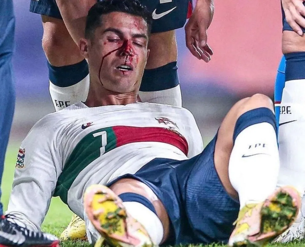 Cristiano Ronaldo recibió un violento golpe en la cara y generó preocupación