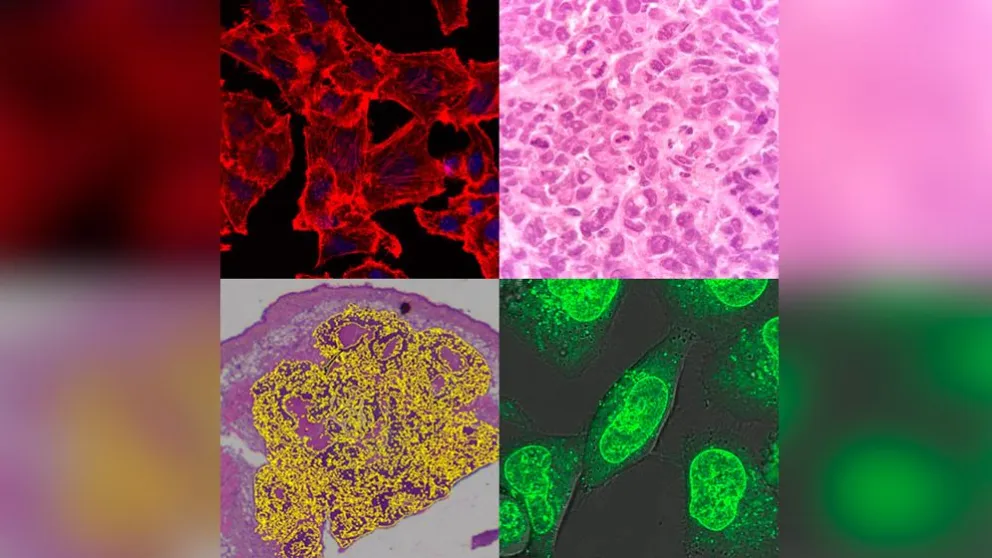 Demuestran en modelos preclínicos que una droga utilizada para tratar la hipertensión tiene efectos antitumorales en osteosarcoma