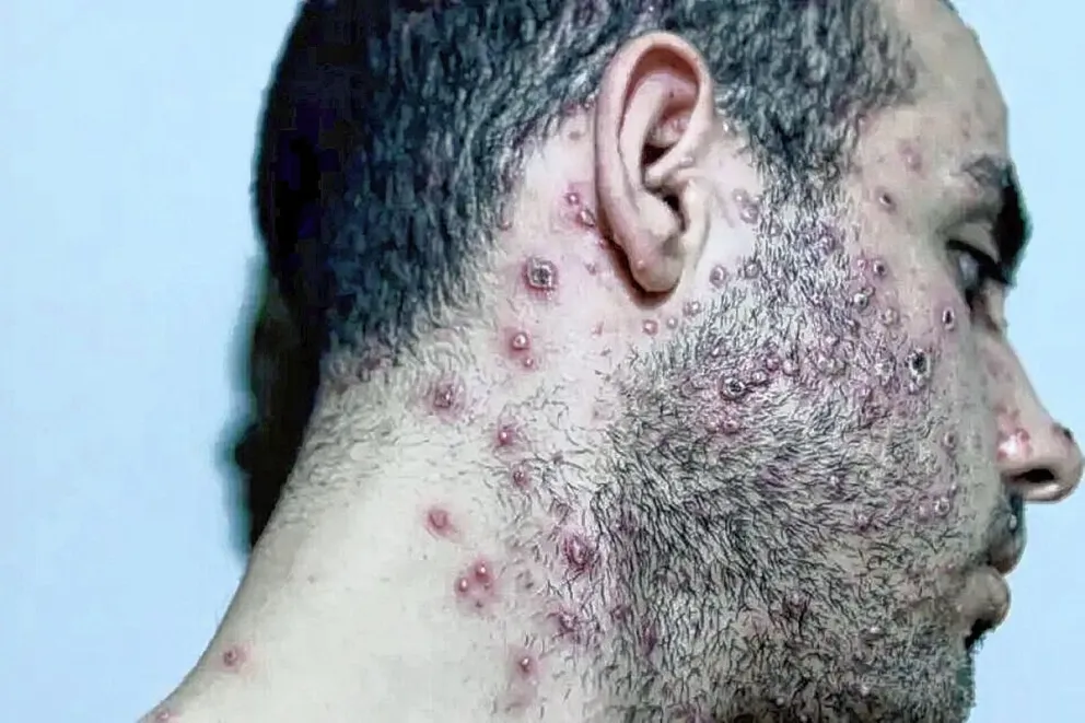 El Ministerio de Salud confirmó el primer caso de Viruela Símica en Chubut