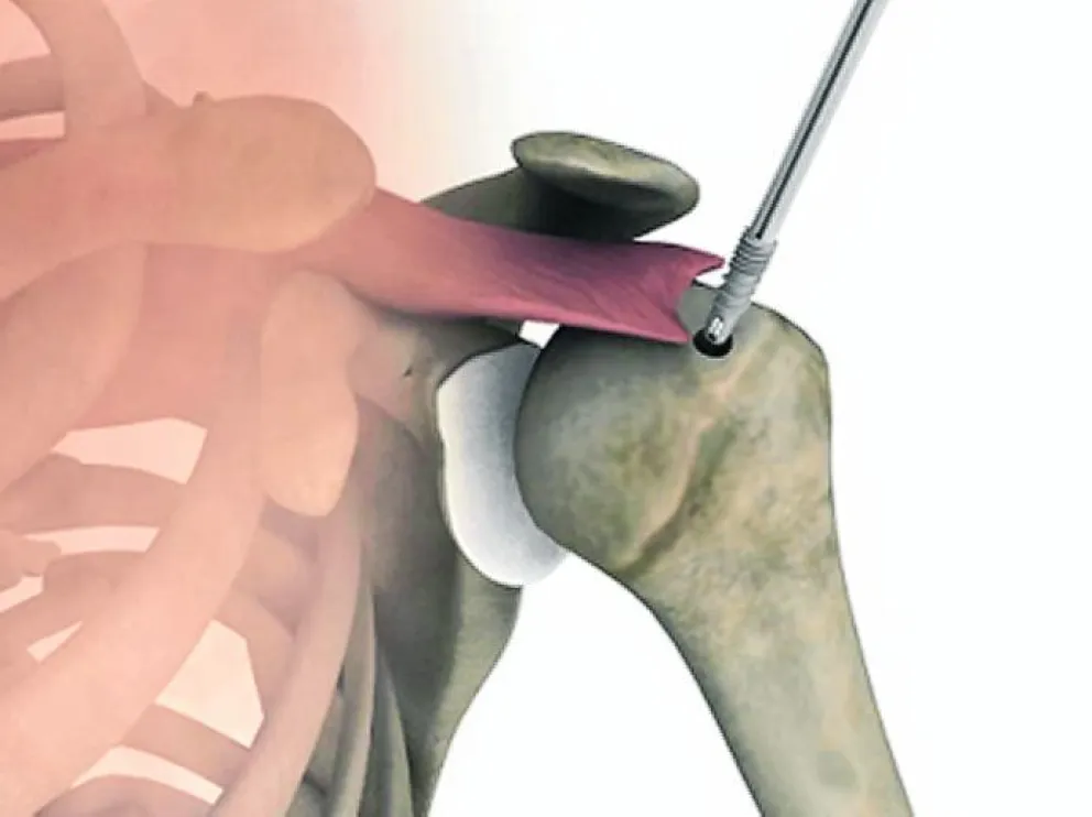 ¿Por qué me duele el hombro cuando hago deporte?