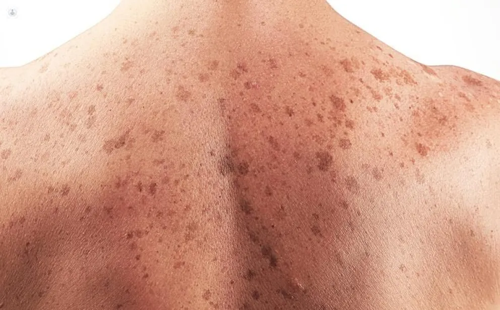 29 Campaña Nacional De Prevención del Cáncer de Piel