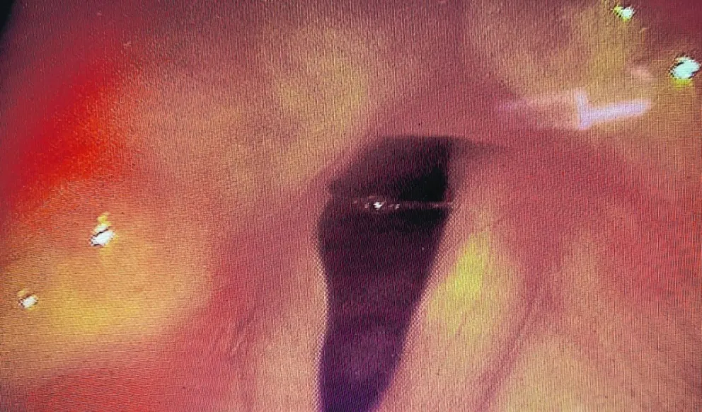 ¿Influye el reflujo gastro esofágico en nuestra voz?