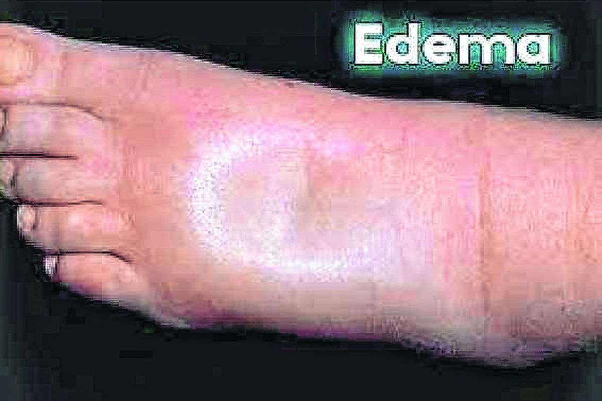Edema