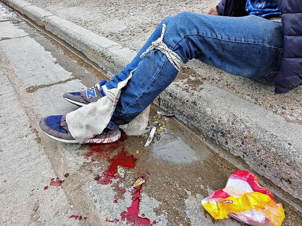 Recibió un disparo en una pierna pero no quiso denunciar el hecho