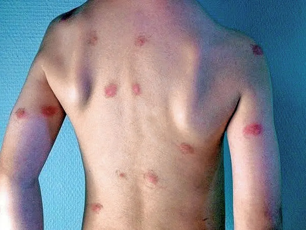 Fumigaron la Escuela 23 a pedido de las familias: habían denunciado a través de las redes que los chicos tenían picaduras de hormigas y pulgas