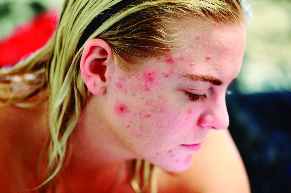 Acne, que es? 