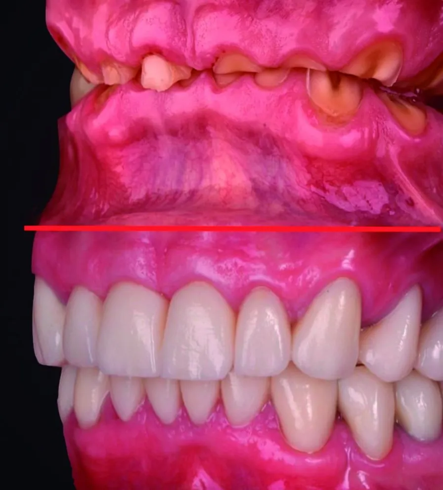 ¿Bruxismo severo, se puede rehabilitar??