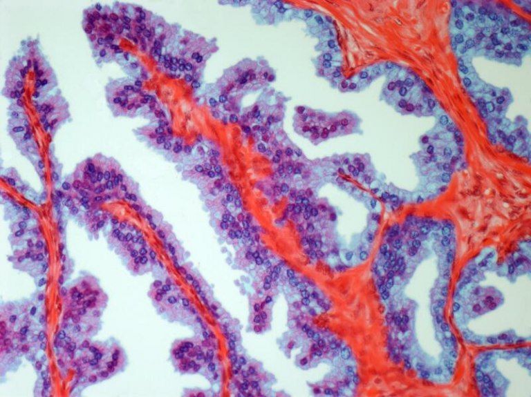 Cáncer de próstata: las terapias innovadoras mejoran las expectativas de pacientes en etapa metastásica