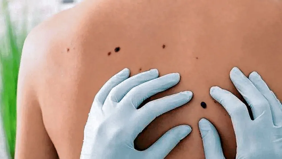 Melanoma: un tumor agresivo que amenaza con convertirse en uno de los más frecuentes