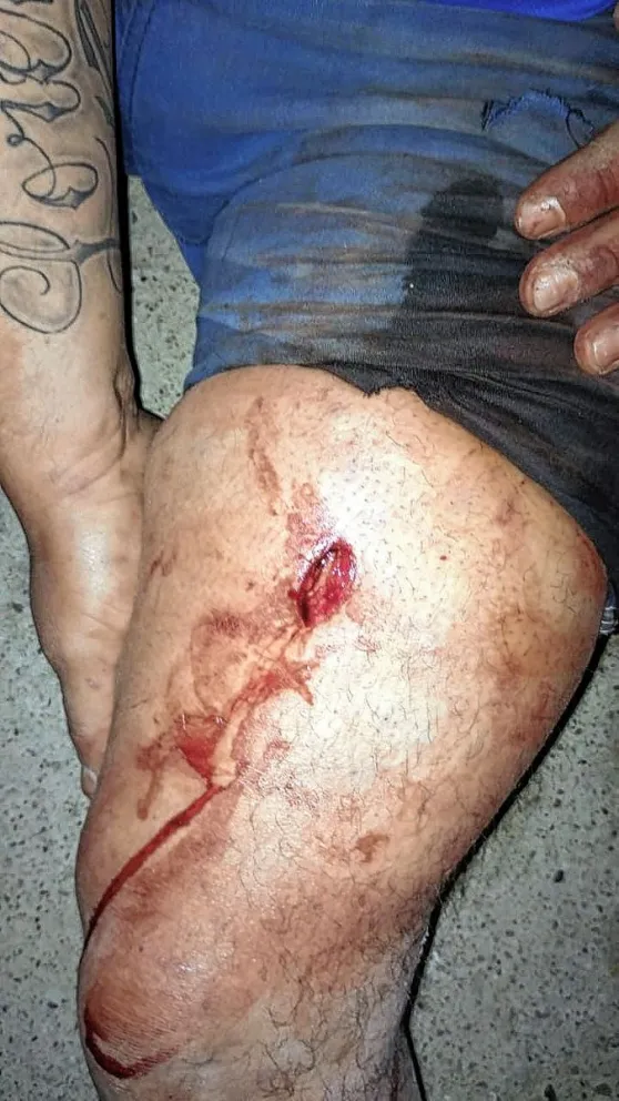 Lo apuñalaron en una pierna pero no quiso radicar la denuncia